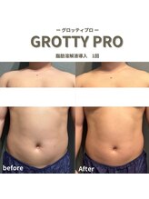 フルアナ(Hu ruana)/痩身/ダイエット/筋膜リリース