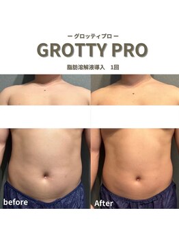 フルアナ(Hu ruana)/痩身/ダイエット/筋膜リリース