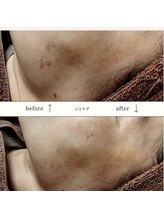 サロン ピューパ(Salon pupa)/シミケアBefore→After