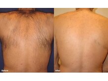 シーケスト(seekest.)/背中の脱毛