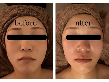 アネクル(ANECUL)/小顔メニュー新登場！