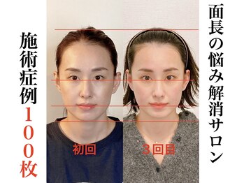 小顔22 ボルティ 赤坂支店(Bolty)