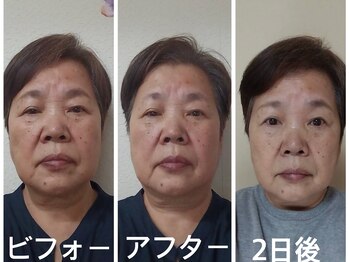 アクアナチュラ(ACQUANATURA)/初めてのエステで小顔矯正!