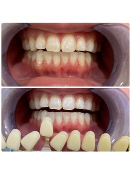 コナホワイトニング 神保町/初回ホワイトニング