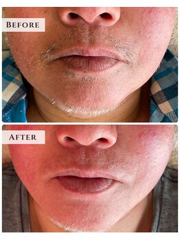 ルアナラウンジ(Luana Lounge)/白髪ヒゲ脱毛の症例