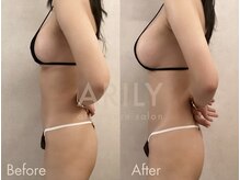 アリリィ(ARILY)/ダウンタイムケア/表参道/外苑前