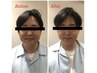 【毛穴黒ずみごっそり】毛穴ピーリング+光フェイシャルで透明肌へ ¥4980