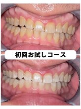 ホワイトニングビューティー 吉祥寺店/ホワイトニング　初来店