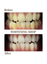 ホワイトニングショップ 大分店/Before&Aftre美白ホワイトニング