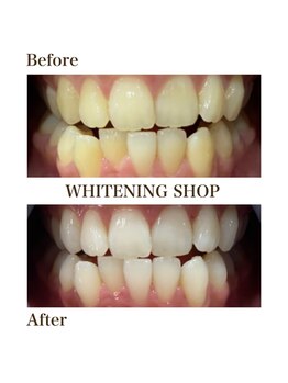 ホワイトニングショップ 大分店/Before&Aftre美白ホワイトニング
