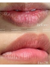 クク(ququ)/ローマピンク症例