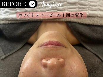 アングレイス(Anngrace)/【本気の肌質改善】圧倒的効果