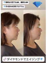 ヴィーナス(Venus)/ダイヤモンドピール/ピーリング