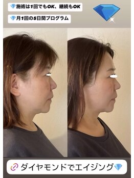 ヴィーナス(Venus)/ダイヤモンドピール/ピーリング