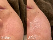 シャルム(Charme)/メンズフェイシャル♪食いしばり