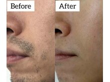 トータルビューティー シーズン(TOTAL BEAUTY Season.)/メンズ　ヒゲ脱毛