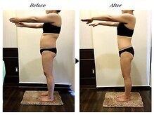 ビューティークリニックコダマ 日向店/【2か月コース】M.N 様 （38歳）