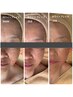 【徹底美白】シミをつくらない増やさない肌へ！最強美白コース¥16500 →¥9900