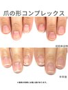 30代/爪の形コンプレックス