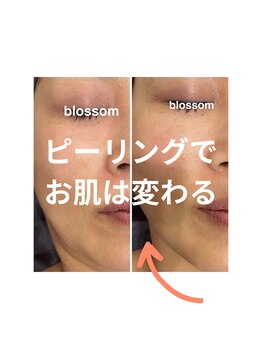 ブロッサム(Blossom)/ホワイトスノーピール1回目