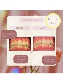 プラスビー 2号店(+b)/ホワイトニングビフォーアフター