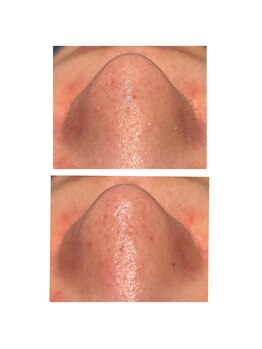 ディシェーレ アスト/ハイドロフェイシャル