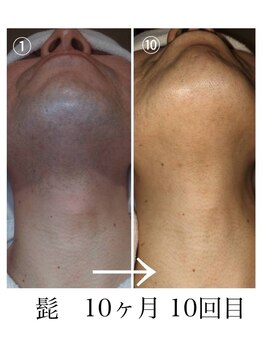 ミスターアンドミス脱毛専門店 難波店(Mr.&Ms.脱毛専門店)/ヒゲ脱毛ての違い