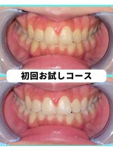 ホワイトニングビューティー 吉祥寺店/ホワイトニング　初来店