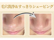 ももとゆでたまごの雰囲気（毛穴の黒ずみ実は「産毛」かも？！/新宿 渋谷 2駅）