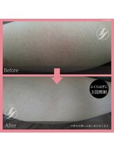 ルル(LULU.)/うで脱毛