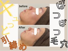 ア クイーユ(Accueil)/ぽつぽつ毛穴をキュッと引き締め