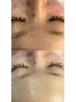 ユウビ ビューティー サロン(Yuubi)/【peel stage】ハーブピーリング