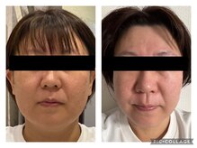 アンフィー 川西能勢口店(Une f`ee)/フェイシャルBefore,After