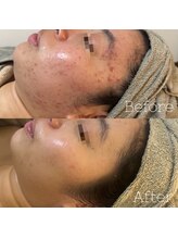 アテ(Ate)/お肌トラブル根本改善で結果出し