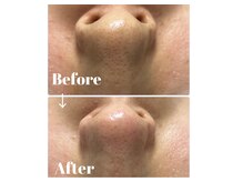 カラーリリー アンド ユン(Calla lily & yun)/気になる毛穴汚れに！