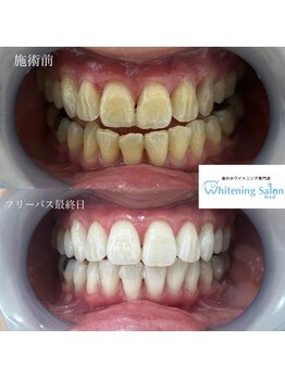 ホワイトニングサロン 熊本店/気軽にホワイトニング