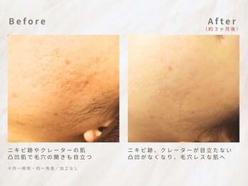 メレ(mele)/20代毛穴／ニキビケア・赤み