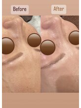 カエデ(Kaede)/【毛穴洗浄×ハーブビフォアフ】