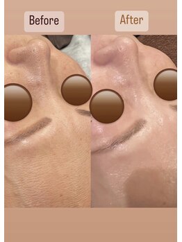 カエデ(Kaede)/【毛穴洗浄×ハーブビフォアフ】