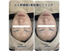 ヴィーナス(Venus)/ヒト幹細胞×美肌菌ピーリング