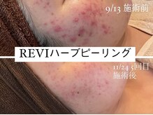 リフレ(Refre)/ニキビケアにもハーブピーリング