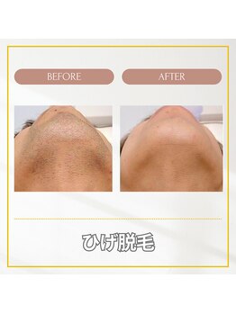 エクレ(EKURE)/男性ヒゲ脱毛