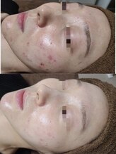 レイ(Lei)/REVIハーブピーリング