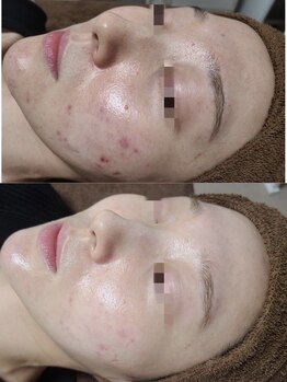 レイ(Lei)/REVI/ハーブピーリング/ニキビ