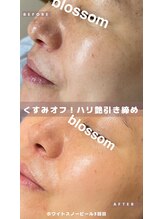 ブロッサム(Blossom)/ホワイトスノーピール3回目