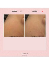 コゼット(Cosette)/目の下のハリアップ↑