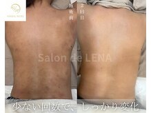 サロン ド レナ(Salon de LENA)/ハーブピーリング サロンドレナ