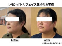 トータルビューティーみつとも/レモンボトル/顔のたるみ/二重顎