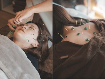 ヒノト(Hinoto)の写真/【美容鍼灸と身体のメンテナンスを同時に】初回からお身体もお顔も驚きの変化！眼精疲労や肩こりにも効果◎