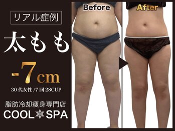 クールスパ(COOL SPA)の写真/太もも・ヒップ専門！脂肪冷却と痩身技術で、憧れの引き締めボディを天神で実現★